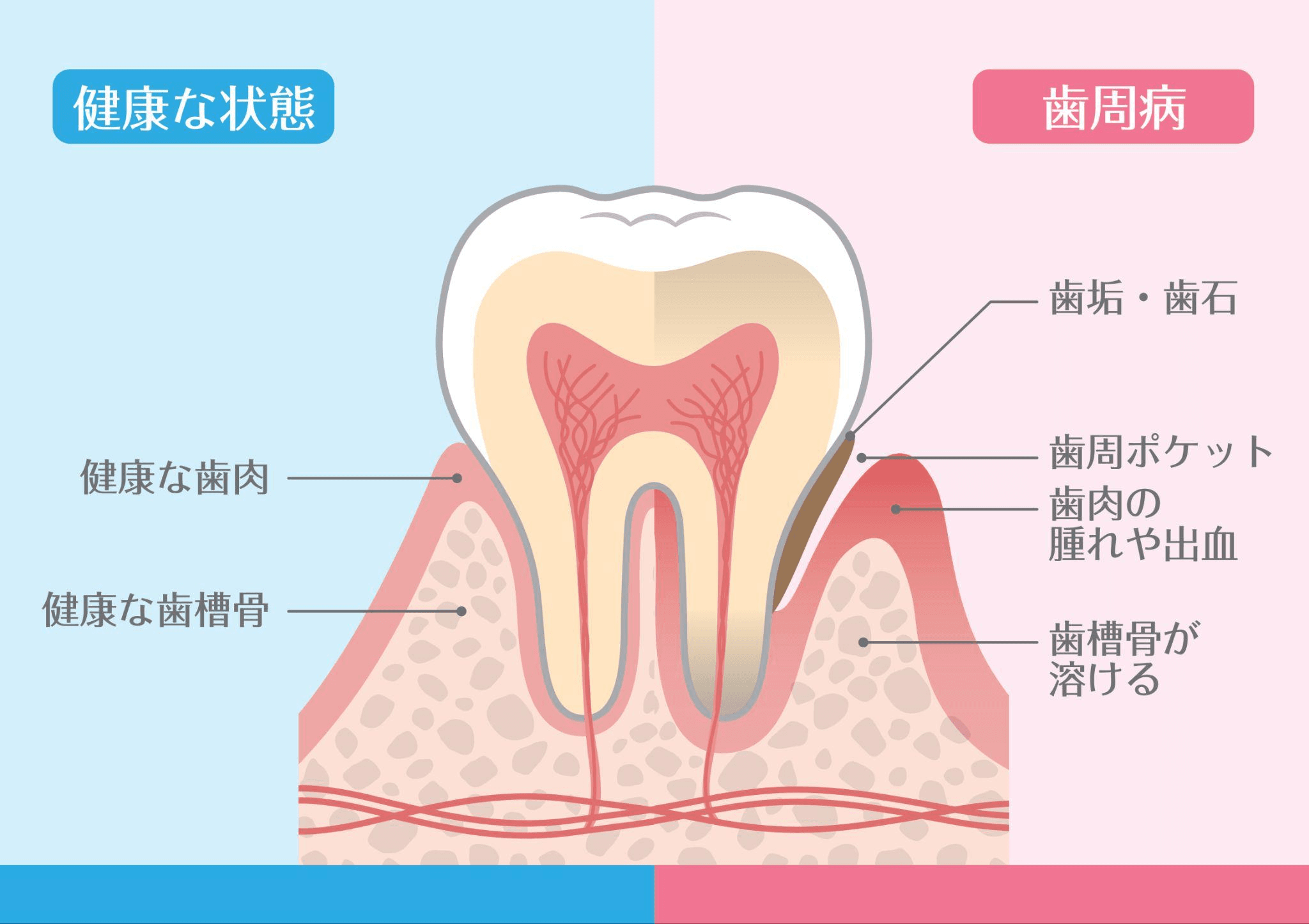歯周病が進行するメカニズム