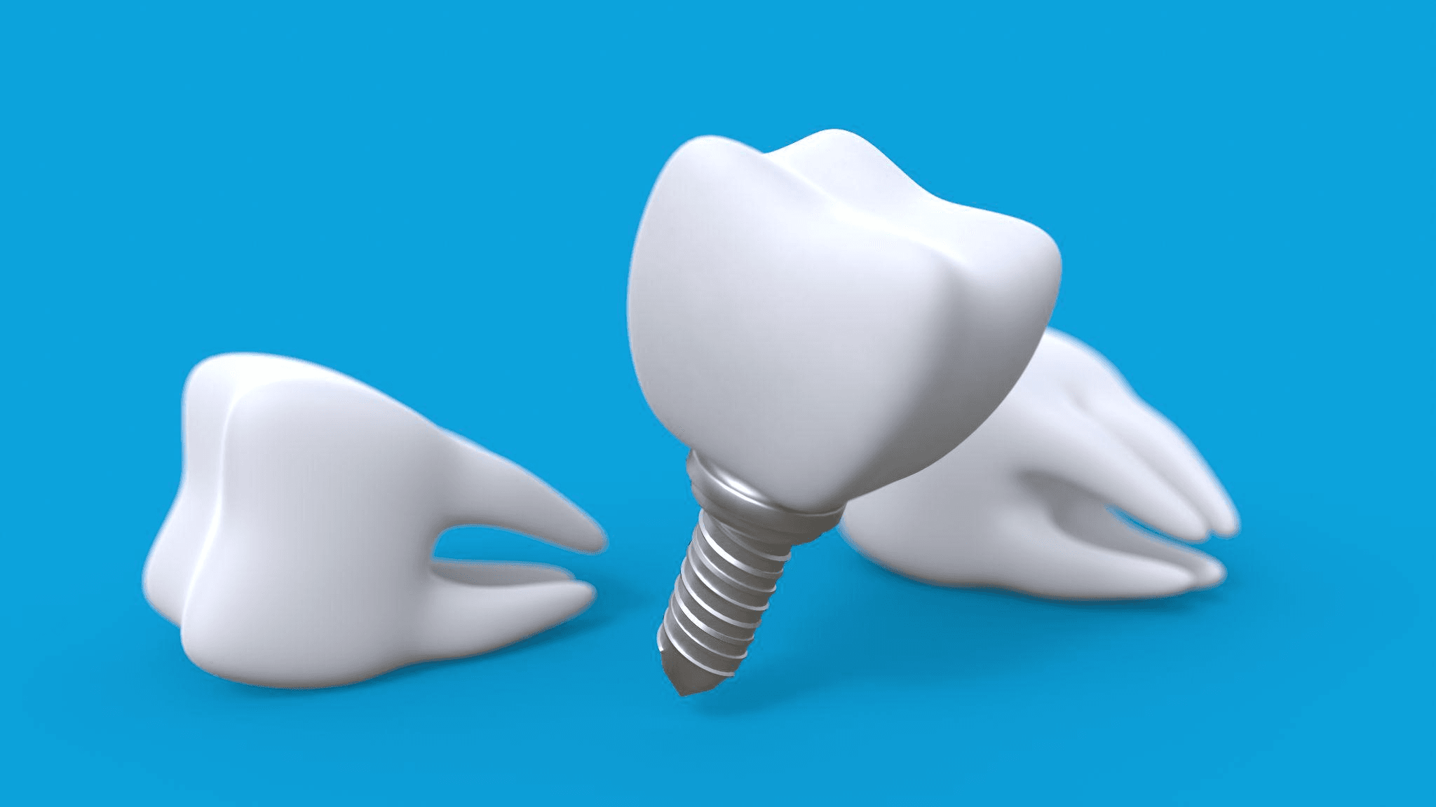 奥歯のインプラントはできるのか　