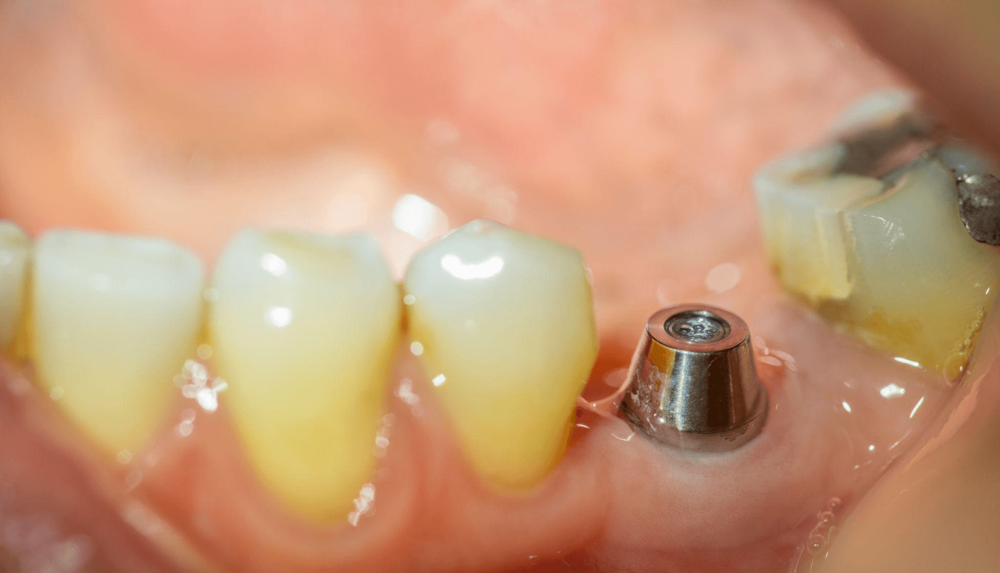 インプラント治療の流れ　